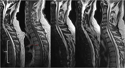 Case Report: A Well-Hidden Cause for Myelopathy